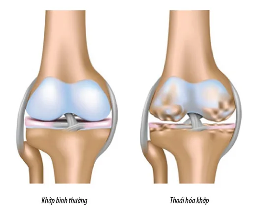 Tổng quan về thoái hóa khớp gối - Bệnh viện SANTE Bình Thạnh, TP.HCM