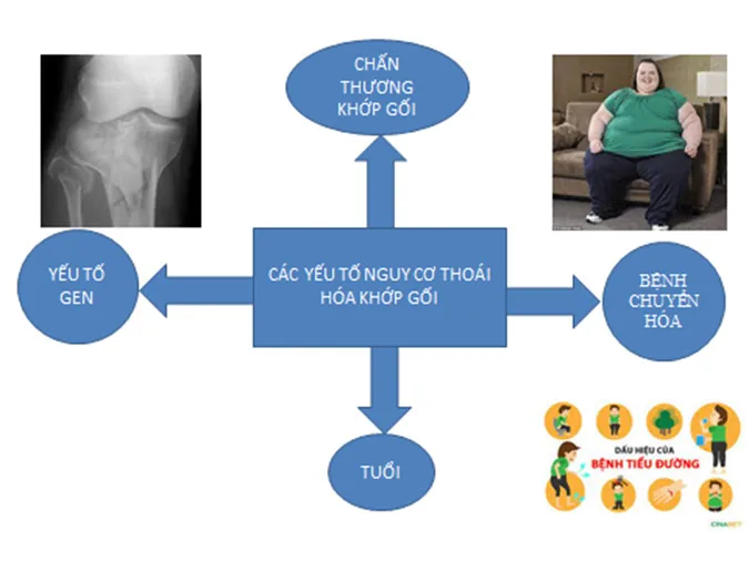 Tổng quan về thoái hóa khớp gối - Hình 2 - Bệnh viện SANTE Bình Thạnh, TP.HCM