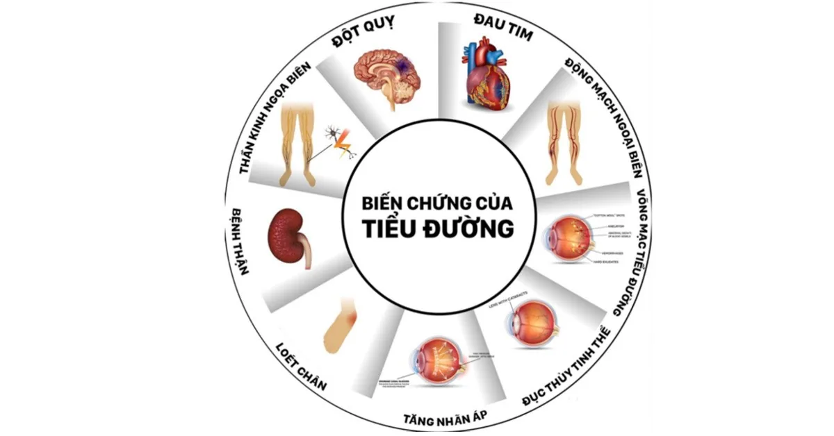 Những kiến thức cơ bản dành cho người bệnh đái tháo đường (ĐTĐ) - Hình 2 - Bệnh viện SANTE Bình Thạnh, TP.HCM Những kiến thức cơ bản dành cho người bệnh đái tháo đường (ĐTĐ) - Hình 2 - Bệnh viện SANTE Bình Thạnh, TP.HCM