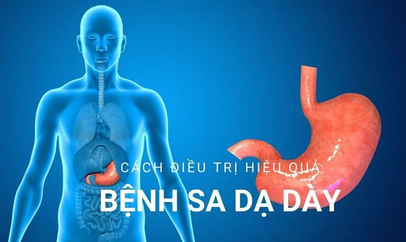 Bệnh viện Sante - Sa dạ dày - Nguyên nhân triệu chứng và cách điều trị