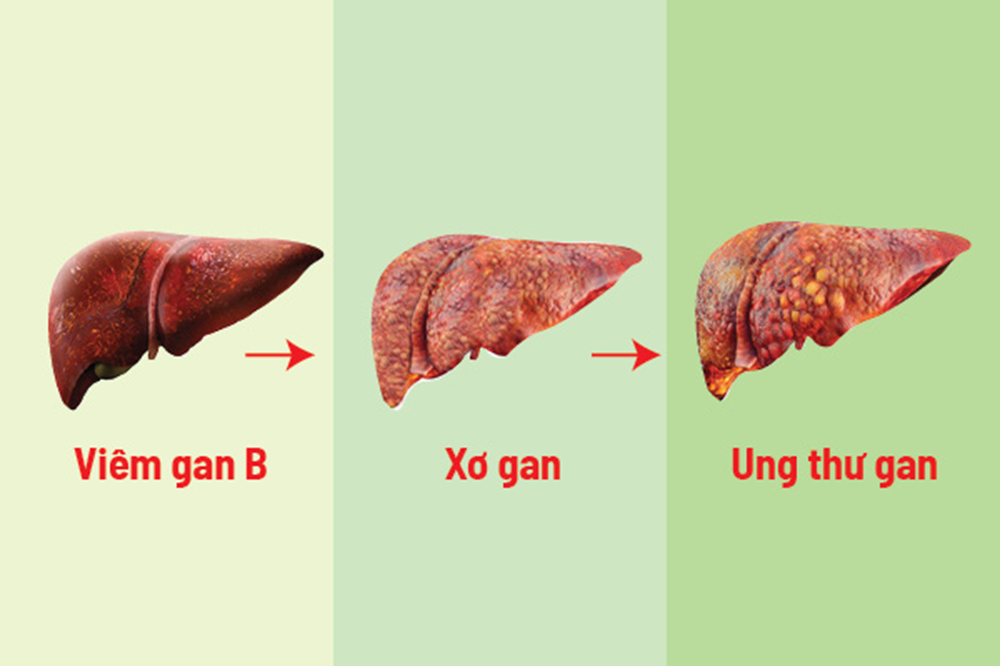 Xơ gan và ung thư gan có phải một? Dấu hiệu nhận biết