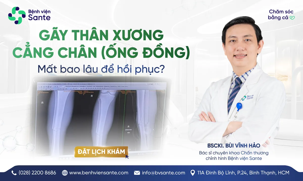 GÃY XƯƠNG CẲNG CHÂN (ỐNG ĐỒNG) MẤT BAO LÂU ĐỂ HỒI PHỤC? - Bệnh viện SANTE Bình Thạnh, TP.HCM GÃY XƯƠNG CẲNG CHÂN (ỐNG ĐỒNG) MẤT BAO LÂU ĐỂ HỒI PHỤC? - Bệnh viện SANTE Bình Thạnh, TP.HCM