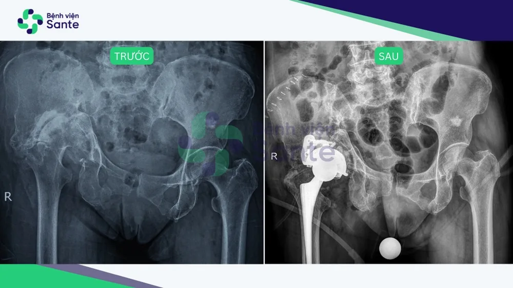 Giải thoát “chân thấp chân cao” sau 50 năm chịu đựng - Hình 2 - Bệnh viện SANTE Bình Thạnh, TP.HCM