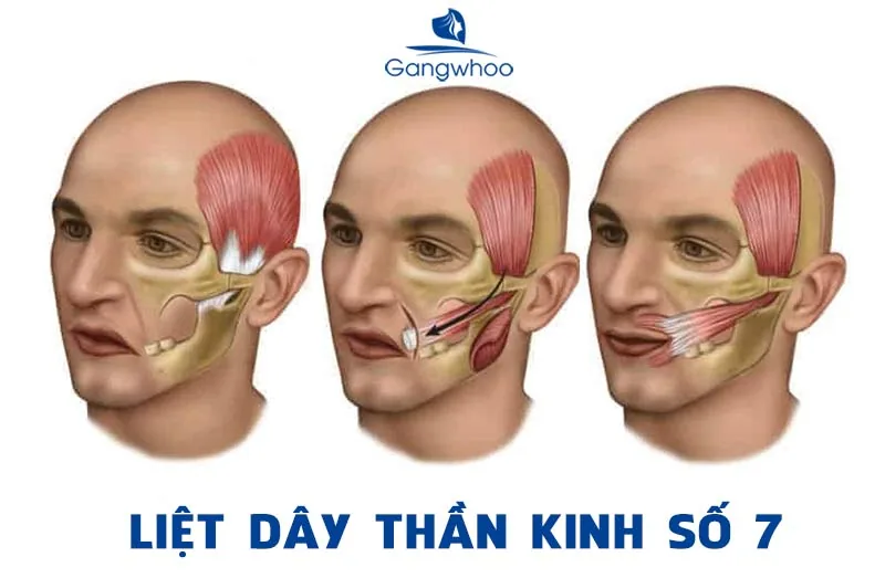 말초성 안면신경마비(벨마비), 안면 변형을 유발하는 질환 - 이미지 2 - 산테(SANTE) 병원 빈탄, 호치민시