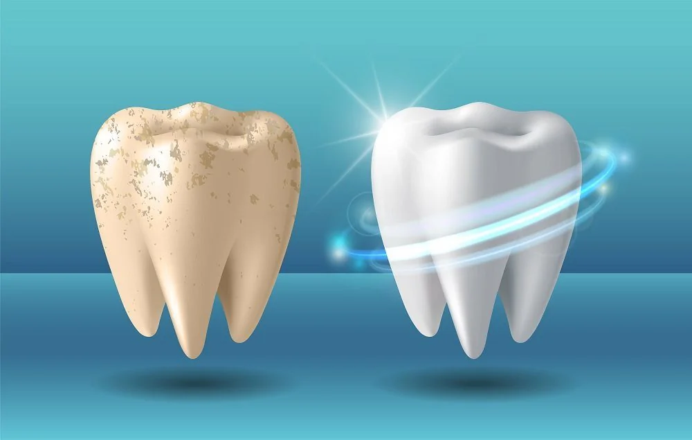 Bệnh viện Sante - Tẩy trắng răng (Hình 2) Bệnh viện Sante - Tẩy trắng răng (Hình 2)