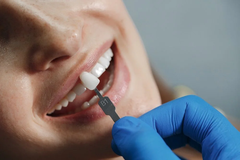Bệnh viện Sante - Veneer sứ (mặt dán sứ) Bệnh viện Sante - Veneer sứ (mặt dán sứ)
