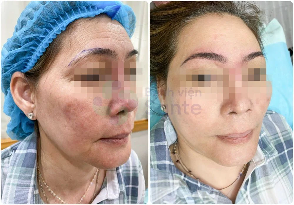 Bệnh viện Sante - Phun xăm thẩm mỹ (Hình 2) Bệnh viện Sante - Phun xăm thẩm mỹ (Hình 2)