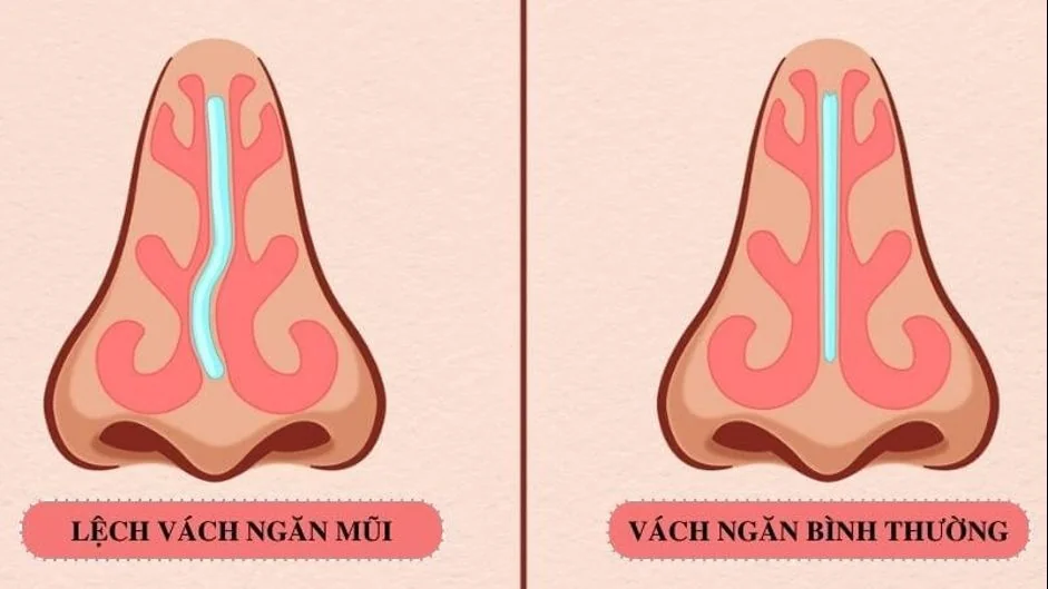 Bệnh viện Sante - LỆCH VÁCH NGĂN MŨI KHI NÀO CẦN PHẪU THUẬT ? (Hình 2)