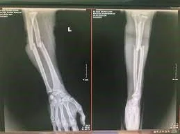 전완부(팔뚝) 골절 X-ray 영상 - 호치민시 빈탄 산테(SANTE) 병원