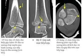 원위 경골 골절 CT scan - 산테 병원 빈탄, 호치민시