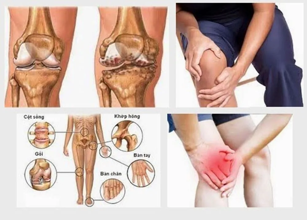 Bệnh viện Sante - Nguyên nhân bệnh đau khớp? Triệu chứng và cách chữa trị (Hình 3)