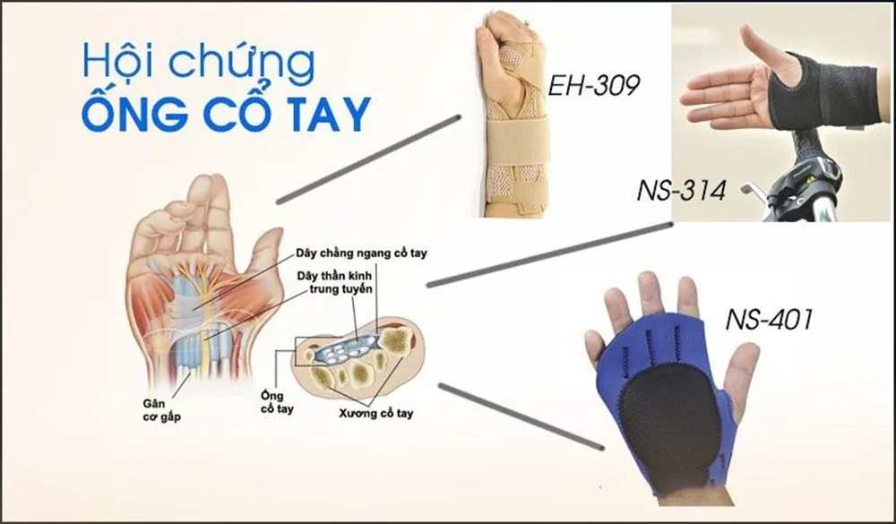 Bệnh viện Sante - Hội chứng ống cổ tay (Hình 3)