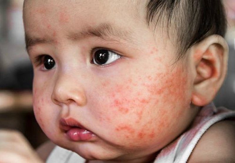 Chàm ở trẻ: Triệu chứng, nguyên nhân và cách chăm sóc đúng