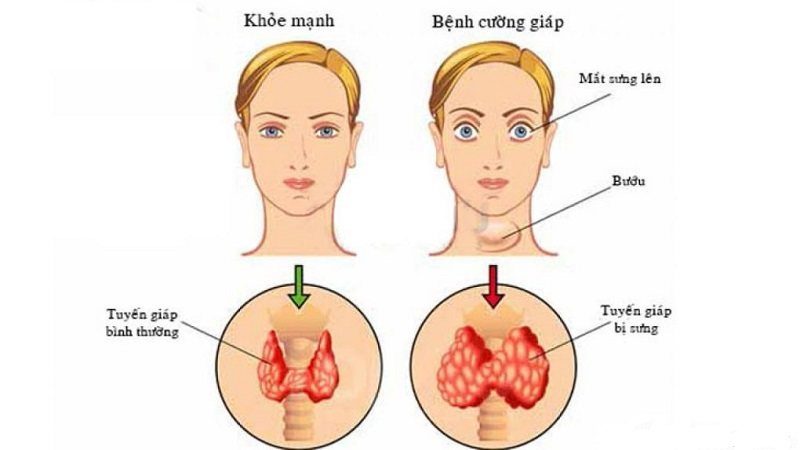 Cường giáp là bệnh gì? Nguyên nhân, dấu hiệu và cách chữa trị