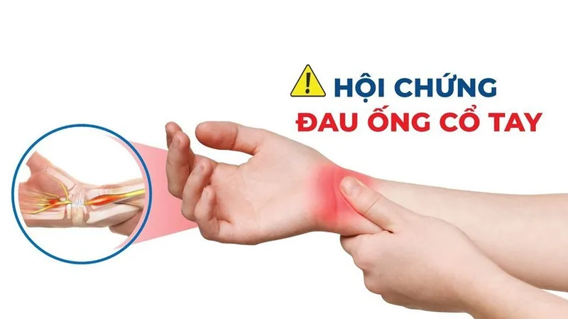 Hội chứng ống cổ tay