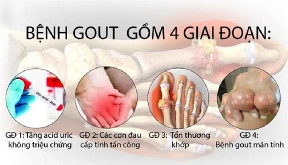 Gout – Không còn là bệnh của người giàu