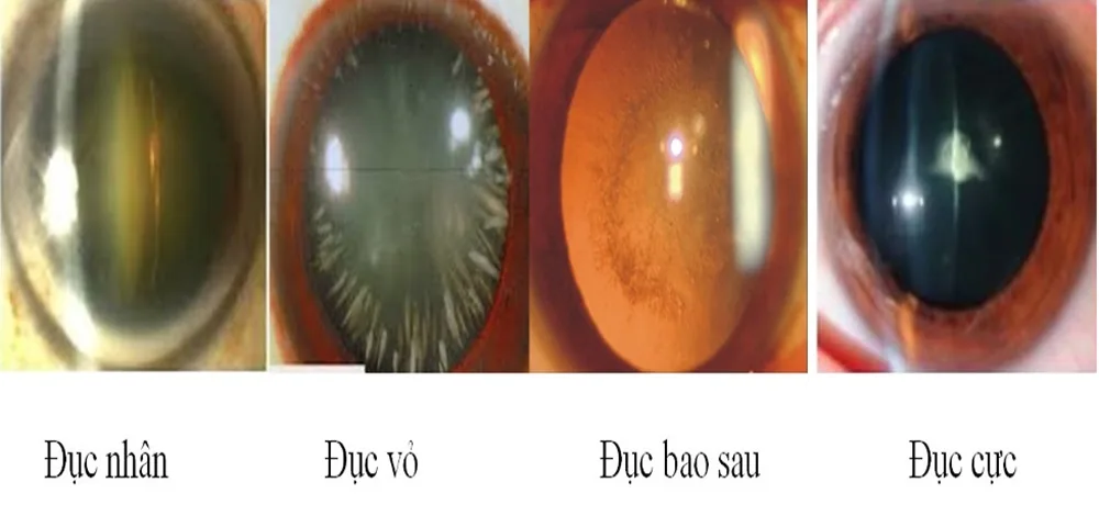 Những bệnh lý nguy hiểm thường gặp ở mắt ai cũng nên cảnh giác - Hình 7 - Bệnh viện SANTE Bình Thạnh, TP.HCM
