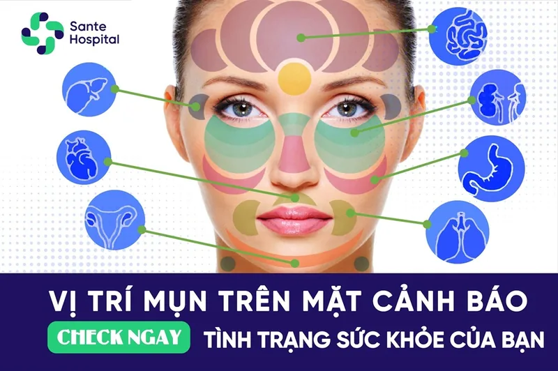 Những vị trí mụn trên khuôn mặt cảnh báo sức khỏe của bạn - Bệnh viện SANTE Bình Thạnh, TP.HCM