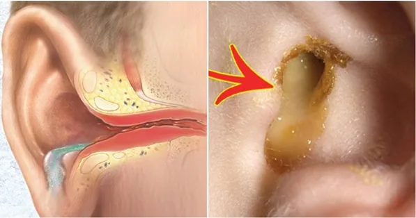 Tai chảy mủ có nguy hiểm không và cách xử lý khi tai bị chảy mủ - Hình 2 - Bệnh viện SANTE Bình Thạnh, TP.HCM