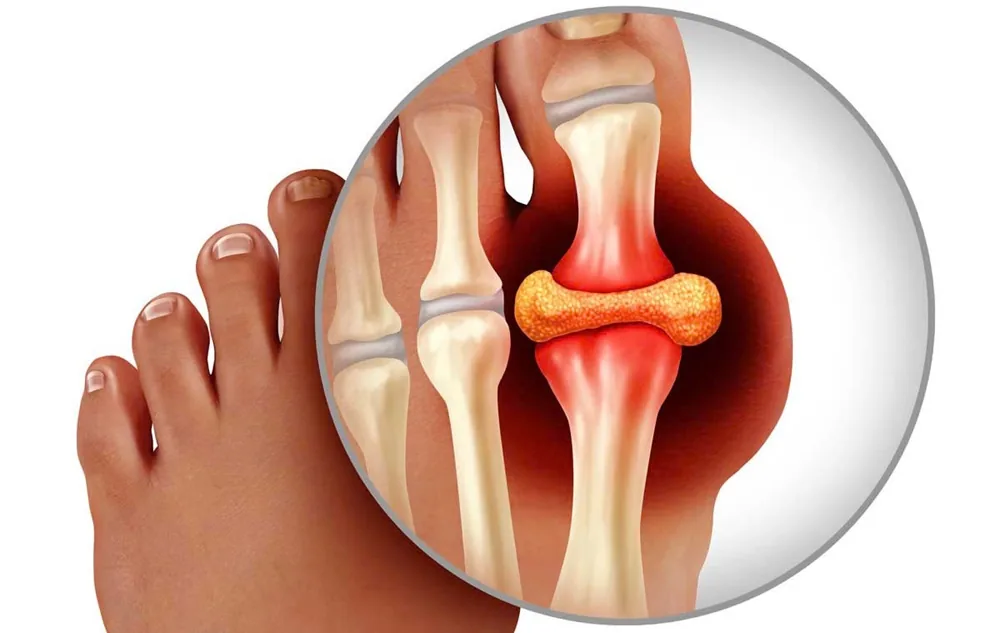 Từ đau nhức đến mất khả năng vận động - Hậu quả của việc lơ là điều trị Gout - Hình 2 - Bệnh viện SANTE Bình Thạnh, TP.HCM Từ đau nhức đến mất khả năng vận động - Hậu quả của việc lơ là điều trị Gout - Hình 2 - Bệnh viện SANTE Bình Thạnh, TP.HCM
