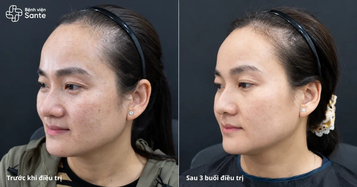 Hình ảnh khách hàng trước và sau 3 buổi điều trị nám tại Khoa Thẩm mỹ Da Bệnh viện Sante