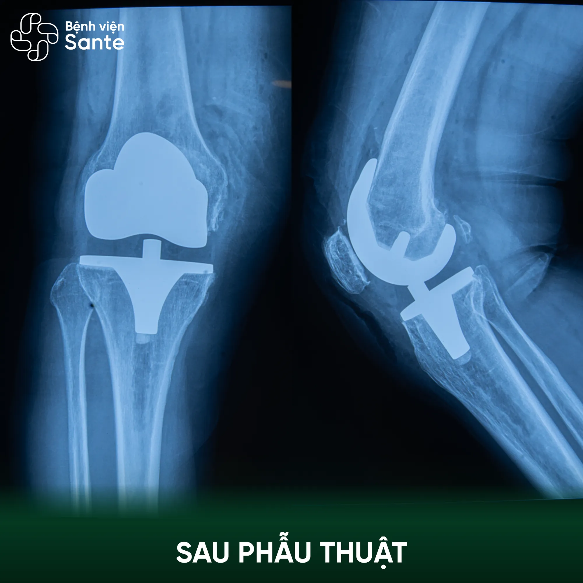 Bệnh viện Sante - Hơn 30 năm đau khớp gối, bệnh nhân 60 tuổi xuất viện sau 24 giờ thay khớp tại Sante (Hình 3) Phim X-quang kiểm tra sau phẫu thuật thay khớp gối nhân tạo tại Bệnh viện Sante