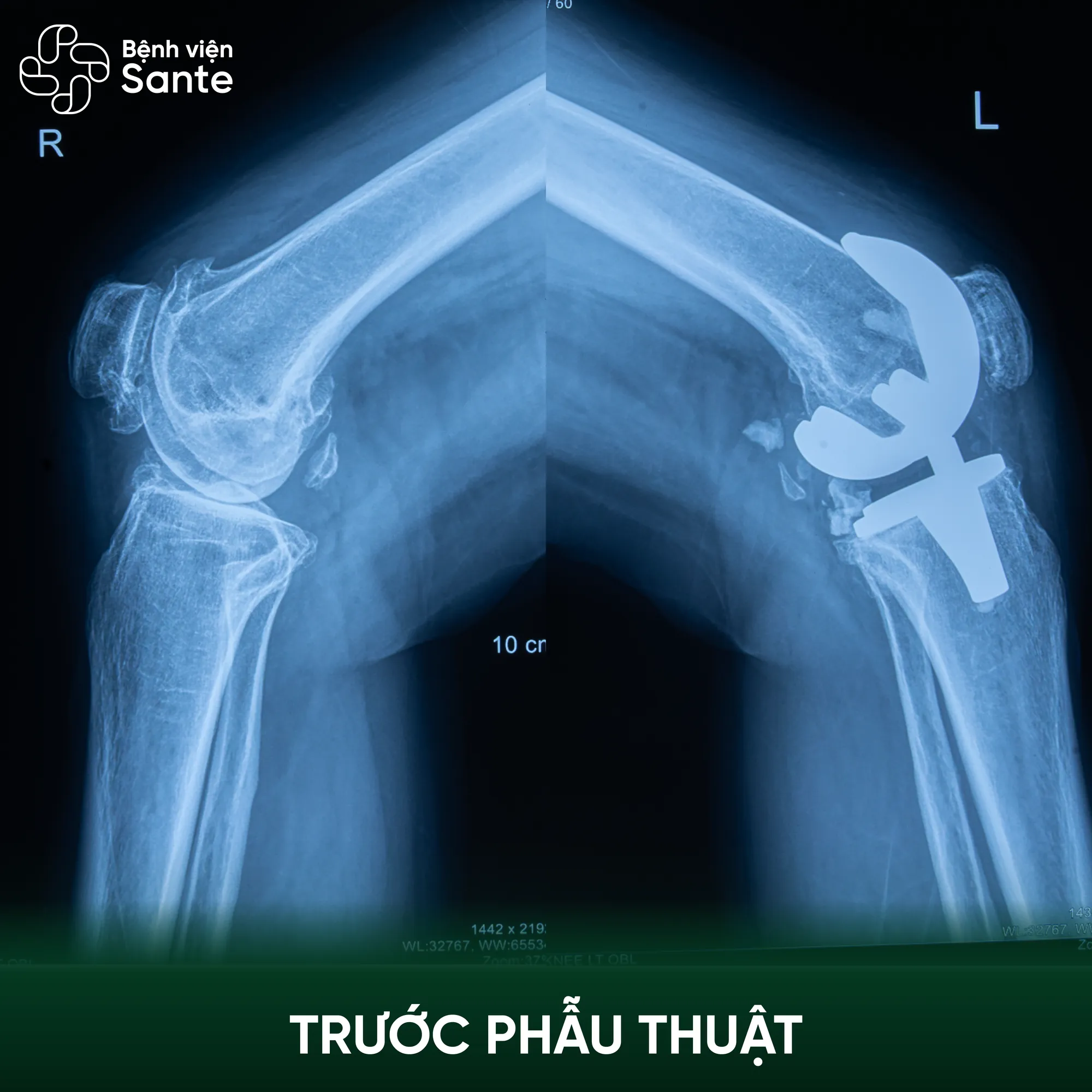 Bệnh viện Sante - Hơn 30 năm đau khớp gối, bệnh nhân 60 tuổi xuất viện sau 24 giờ thay khớp tại Sante Phim chụp X-quang khớp gối của cô Hương trước phẫu thuật ghi nhận thoái hóa nặng tại Bệnh viện Sante