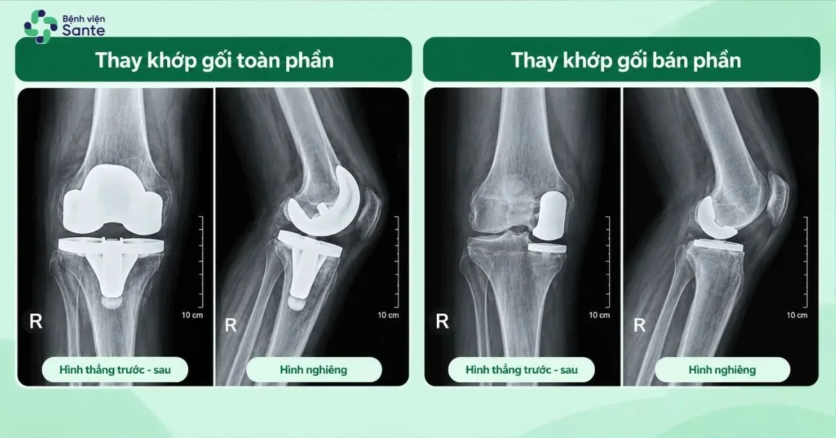 Bệnh viện Sante - Thay Khớp Gối Là Gì? Chỉ Định, Quy Trình & Phục Hồi Sau Mổ (Hình 4) Phim X-quang so sánh thay khớp gối toàn phần và bán phần